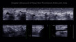 Color Doppler ultrasound determination in deep vein thrombosis patients for finding  deep vein thrombosis of lower extremity.