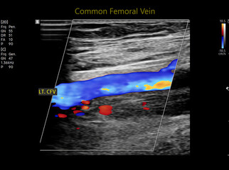 Color Doppler ultrasound determination in deep vein thrombosis patients for finding  deep vein thrombosis of lower extremity.