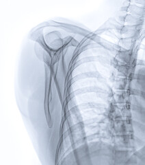 Poster - X-ray of Shoulder joint  transcapula view  showing normal scapula bone