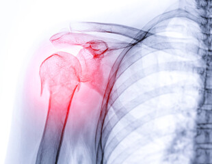 Poster - X-ray of Shoulder joint  showing fracture of humerus bone.