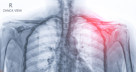 Poster - X-ray of Clavicle bone  showing fracture of  Clavicle bone  .