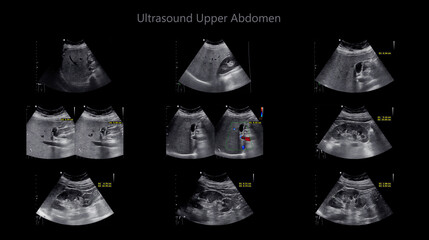 Sticker - Ultrasound upper abdomen showing  Liver and gall bladder for screening hepatic cell carcinoma and gallstone.