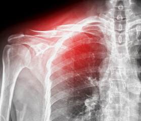 Poster - X-ray of Clavicle bone  showing fracture of  Clavicle bone  .