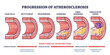 Progression of atherosclerosis and thrombosis formation outline diagram. Labeled educational medical stages with endothelial dysfunction development to vein complicated lesion vector illustration.
