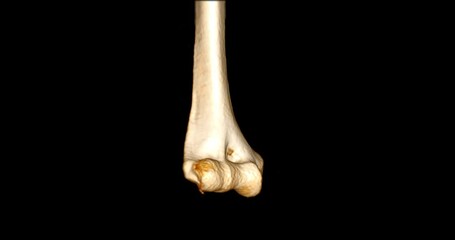 Poster - CT scan of Elbow joint 3D rendering image turn around on the screen .