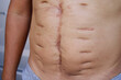 © SuperMoo Varavut - A large scar on the skin of an Asian man's abdomen was caused by major surgery, The longitudinal convex scar is a scratch from the stitches, The body suffered a large wound from hospital treatment.