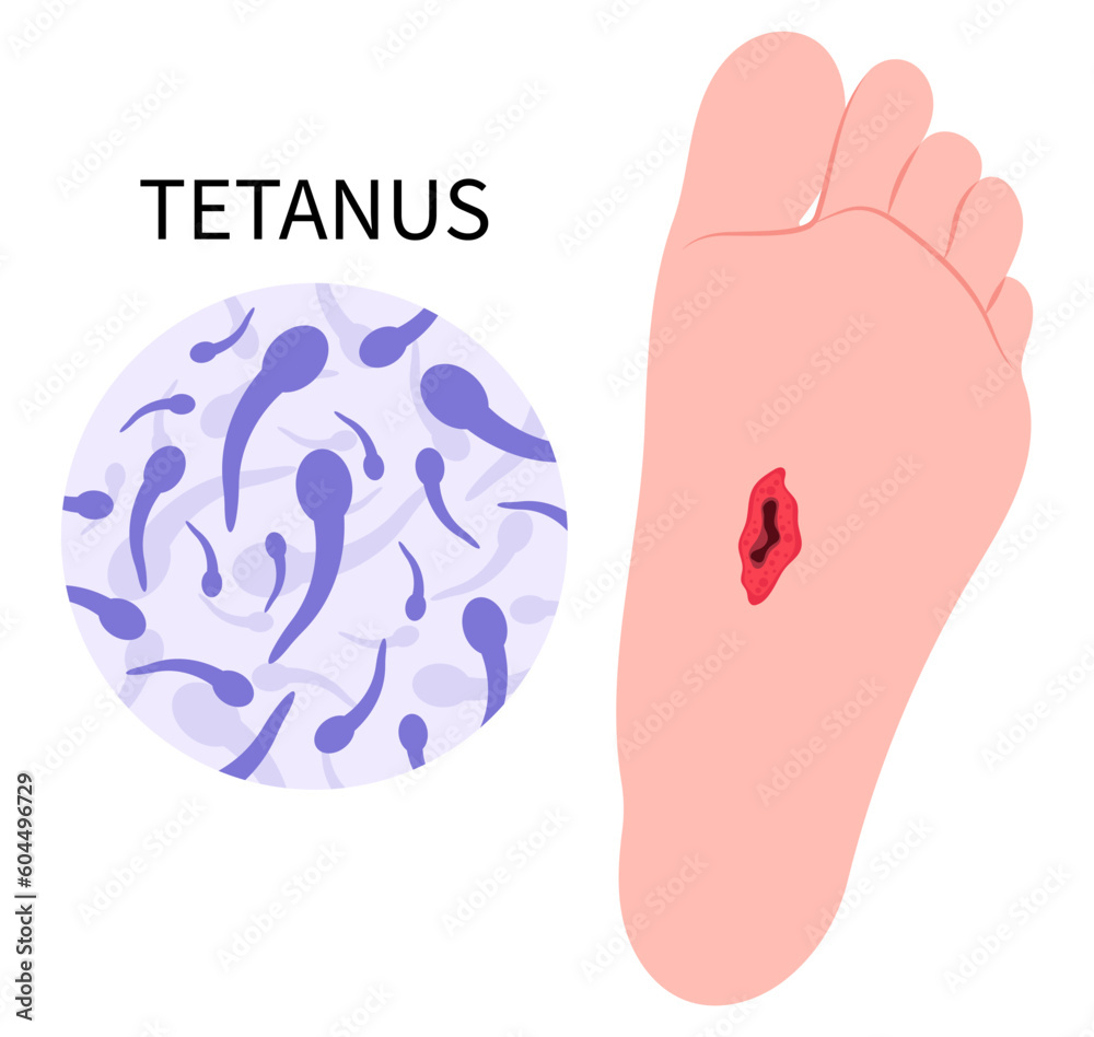 Tetanus Graphics Stock-Vektorgrafik „Tetanus infection bacteria Clostridium tetani virus ...