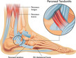 Medical illustrations of symptoms of peroneal tendonitis, with enlargement of the affected area, with annotations.