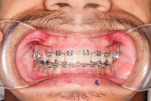 Frontal View Of Dental Arches In Biting Teeth Occlusion, Orthodontic Braces, Elastic O-ring Ligature And Metallic Arch Wire.  Healthy Gingival Gum, Cheeks And Lips Retracted With Cheek Retractor.