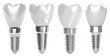 Set of dental implant models of molar teeth, cut out, as a concept of implantation teeth and dental surgery. Based on Generative AI