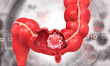 Human colon cancer. 3d illustration