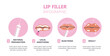 Lip filler infographic. Data visualization and tutorials. Botox injections and facelifting, plastic surgery. Beauty, elegance and aesthetics. Flat vector illustration isolated on white background
