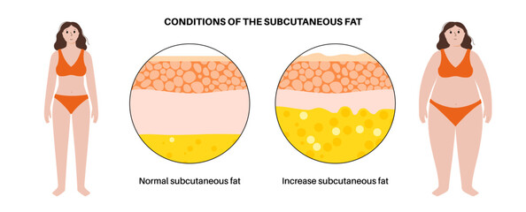 Wall Mural - Obesity fat level