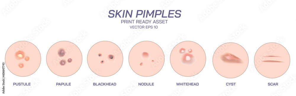Module Pimple Skin Pimples and acne vector illustration. Appearance of the different ...