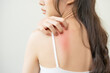 © KMPZZZ - Dermatology, asian young woman, girl allergy, allergic reaction from atopic, insect bites on her back, hand in scratching itchy, itch red spot or rash of skin. Healthcare, treatment of beauty.