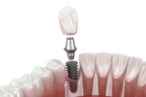 Fototapeta Kosmos - Tooth recovery with implant. 3D illustration with transparent background