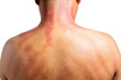 The red mark on the man's back was caused by Gua Sha. Gua sha is a natural alternative therapy to improve blood circulation or to cure cold symptoms