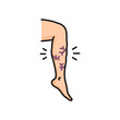 Varicose vein, venous edema, hypoproteinemia treatment disease isolated color line icon. Vector venous disease leg swelling, vascular mesh on legs