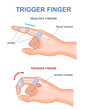 Trigger finger diagram. Joints stuck in bent position. Anatomy of tendons and bones of hand index finger. Medical trauma flexor tendon from inside educational scheme. Cartoon flat vector illustration