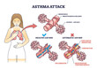 Asthma attack explanation compared with healthy air way outline diagram. Labeled educational scheme with mucus production and inflammation in lungs vector illustration. Anatomical respiration system.
