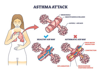 Sticker - Asthma attack explanation compared with healthy air way outline diagram. Labeled educational scheme with mucus production and inflammation in lungs vector illustration. Anatomical respiration system.