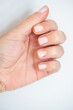 © berna_namoglu - female hand finger nail with fungal infection