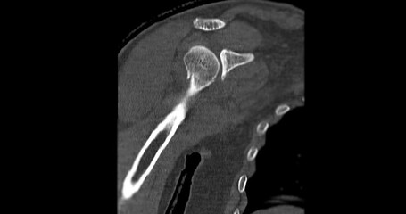 Poster - CT scan of  shoulder joint Coronal view showing fracture head of humerus .