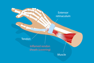 3D Isometric Flat Vector Conceptual Illustration of De Quervain Syndrome, Occupational Disease of the Hand