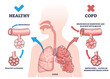 COPD or chronic obstructive pulmonary disease explanation outline diagram. Labeled educational medical scheme with healthy and respiratory illness lungs comparison vector illustration. Body diagnosis
