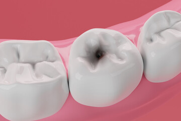 Sticker - Teeth decay by bacteria 3D rendering.