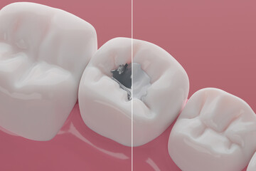 Wall Mural - Teeth Mercury or Silver Amalgam Fillings Compare to Composites, Declay treatment and Dental clinic illustration concept. 3D rendering