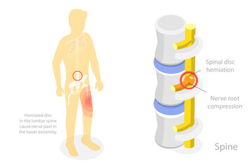 3D Isometric Flat  Conceptual Illustration of Sciatica Nerve Pain