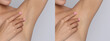 Before and after epilation. Collage with photos of woman showing armpit on light background, closeup