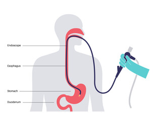 Wall Mural - Gastroscopy endoscopy procedure