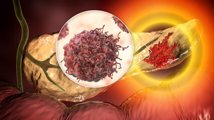 Poster - Pancreatic cancer, tumor of pancreas with close-up view of cancer cells, 3D illustration