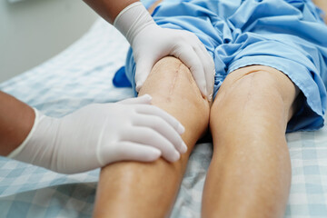 Doctor checking Asian elderly woman patient with scar knee replacement surgery in hospital.