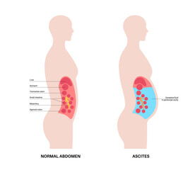 Wall Mural - Ascites disease poster