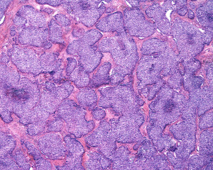 Poster - Human ovary carcinoma