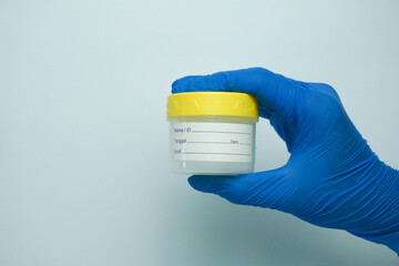 Hand holding urine sample container for medical urinalysis. Urine analysis in the laboratory. Medical urine tests. Urine sample for laboratory analysis.