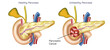 Realistic human pancreas diseases vector illustration. cystic fibrosis, annular pancreas, acute pancreatitis, enlarged pancreas, pancreas inflammation, anatomic abnormality. endocrine, exocrine. 