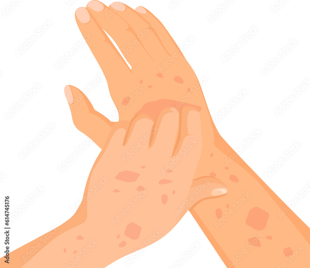Mas Rash Vector de Stock Rash skin on hand. Rashes itching hands scratch arm in ...