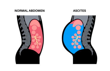 Wall Mural - Ascites disease poster