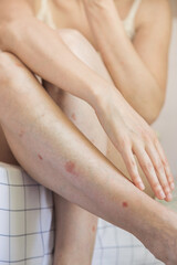 Wall Mural - Close up of a person holding a leg. Body detail of Caucasian woman showing acceptance despite having skin problems. Concept of inclusion and self esteem.