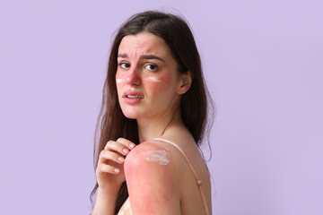 Allergic young woman with sunburned skin and cream on lilac background, closeup