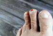 Bleeding on the tip of the second toe of the left foot, insult of the foot toe resulting in a bleeding wound that needs care and bandage, blood on toenail that needs medical attention, selective focus
