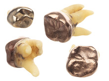 Pulled Molar Tooth With Gold Crown To Show Many Angle, Advanced Caries Rotten Tweezer On Root Bone So Dentist Has To Pull Tooth Out. Long Root Teeth Molar On White Background Isolated