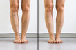 © Andrey Popov - Person Leg With Varicose Veins And Capillaries Before