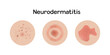 Neurodermatitis examples vector illustration design, allergic problems