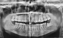 Dental X-ray With Impacted Wisdom Tooth
