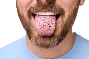 Dry mouth symptom. Man showing dehydrated tongue on white background, closeup